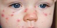 Bu ölkədə qızılca epidemiyası elan edildi