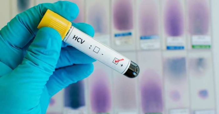 ŞAD XƏBƏR: “Hepatit C” virusuna yoluxan xəstələr - 3 aya tam sağalacaqsız