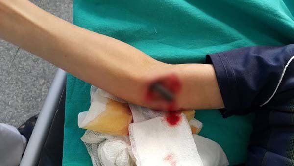 10 yaşlı uşağın başına iş gəldi Həkimlər belə inana bilmədi - Qorxunc olay FOTOLARDA