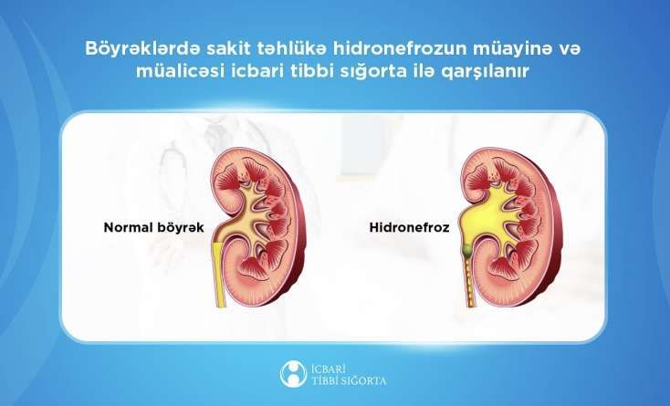 Bu xəstəliyin müalicəsini icbari tibbi sığorta qarşılayır